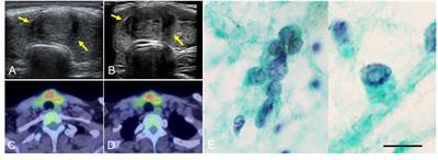 Case Report: Solid variant of papillary thyroid carcinoma in a young adult with Turner syndrome with chronic thyroiditis